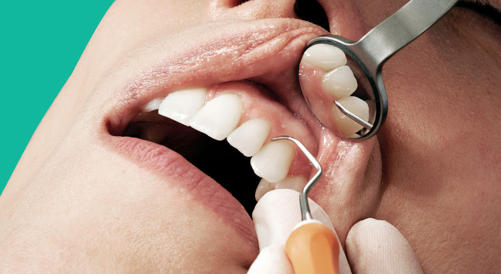 Prevenzione della salute orale